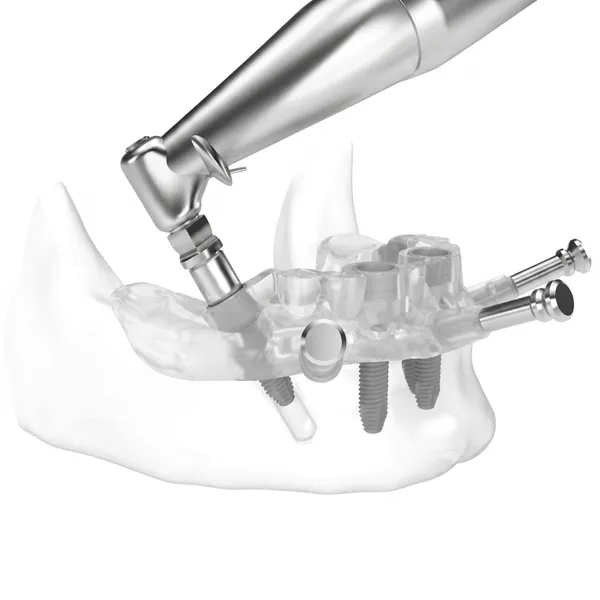 3D-printed surgical guide used to plan and place dental implants