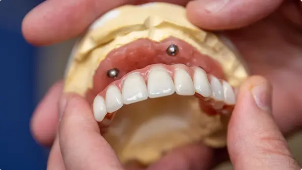 Dental prosthesis materials