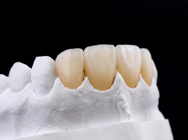 Full-arch zirconia teeth — the final prosthetic