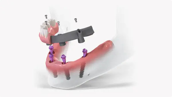 Dental implant components