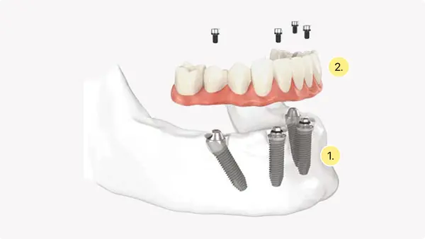 Diagram showing implant and prosthesis components