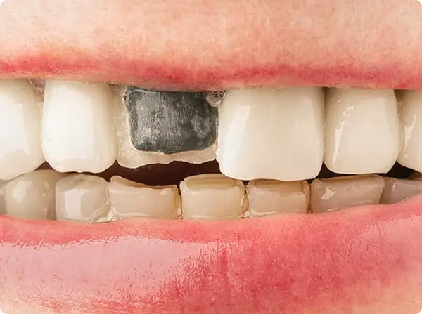 PFM prosthesis example